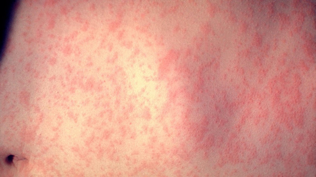 薩摩亞麻疹疫情增至32死 幼童受害最嚴重