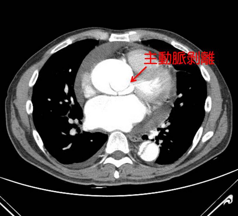 主動脈剝離「前胸痛到後背」 醫：常見於抽菸、高血壓控制不良者