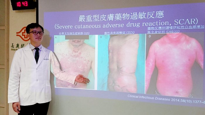 2成台灣人具特殊基因 治青春痘藥有致命危機