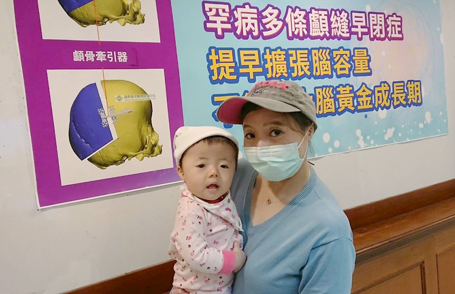 寶寶頭型像卡通「辛普森家庭」角色 醫師提醒恐是顱縫早閉
