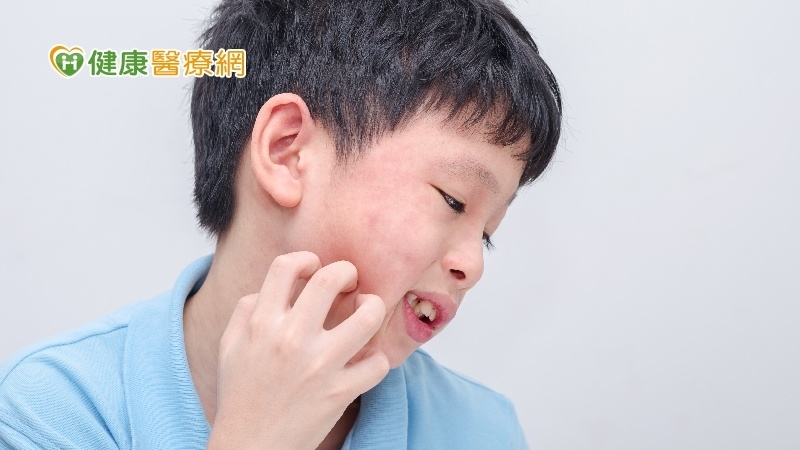 藥物過敏嗎？留意6症狀「疹、破、痛、紅、腫、燒」