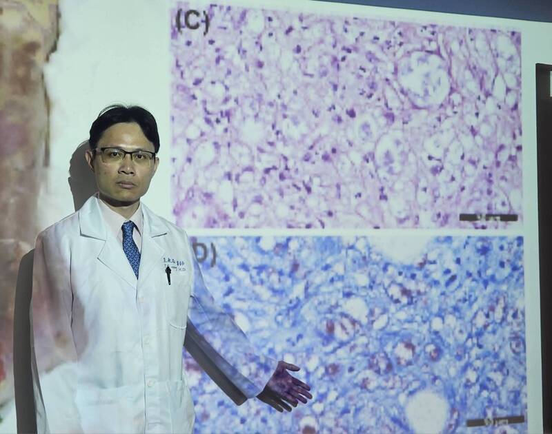 32歲移工染漢生病四肢壞死 搶救近2個月不治