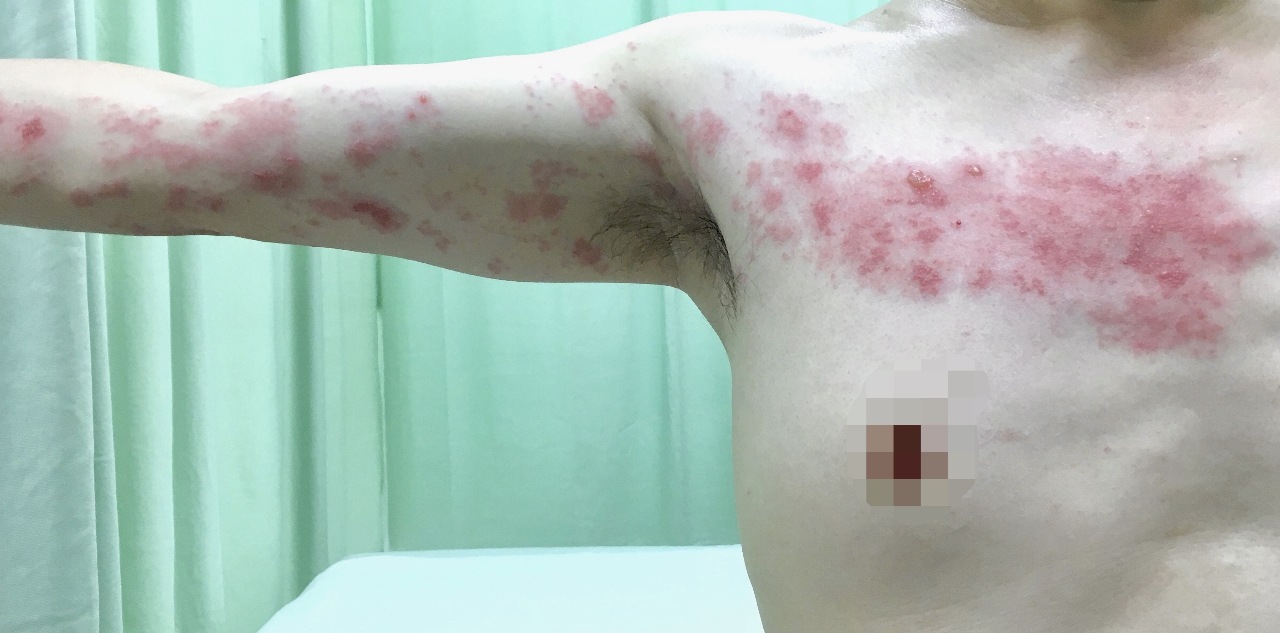 連名人也受害的帶狀疱疹之苦